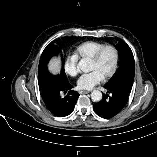 Acute pancreatitis (Radiopaedia 85146-100701 Axial C+ portal venous phase 8).jpg