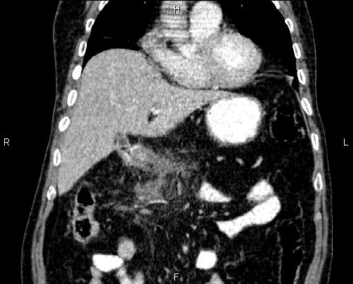 Acute pancreatitis (Radiopaedia 85146-100701 Coronal C+ portal venous phase 24).jpg