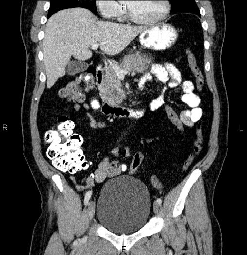 File:Acute pancreatitis (Radiopaedia 85390-101010 Coronal C+ portal venous phase 28).jpg