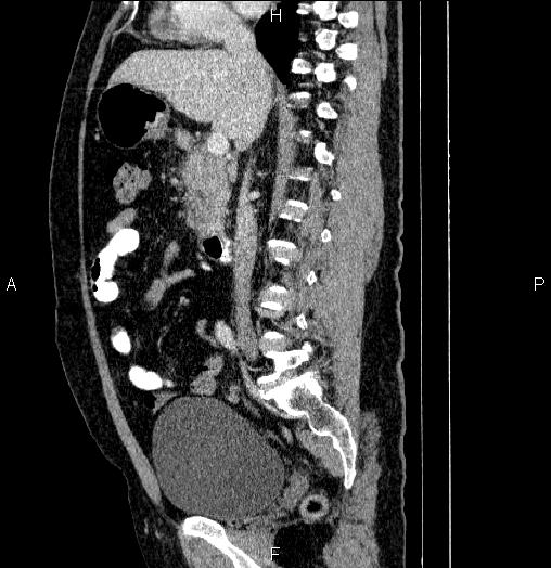 Acute pancreatitis (Radiopaedia 85390-101010 Sagittal C+ portal venous phase 44).jpg