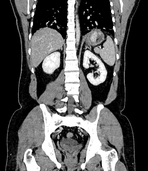 Acute pancreatitis (Radiopaedia 87428-103757 Coronal C+ portal venous phase 65).jpg
