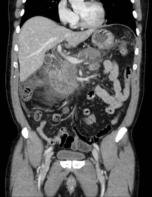 Acute pancreatitis - Balthazar E (Radiopaedia 23080-23110 Coronal C+ portal venous phase 32).jpg