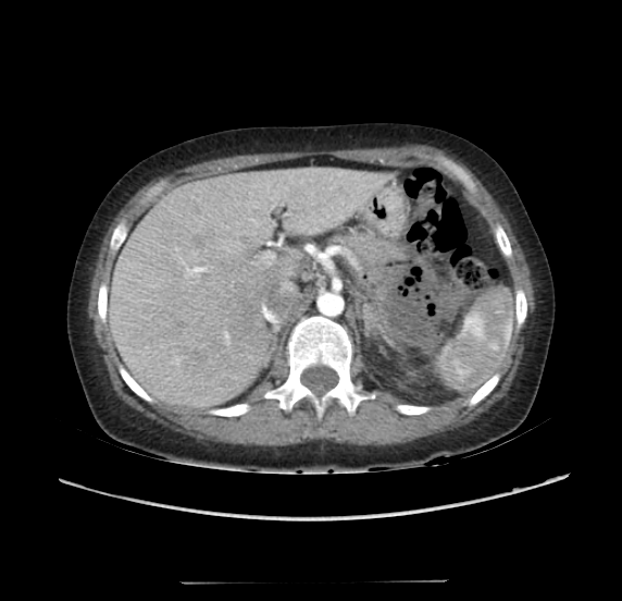 File:Acute pancreatitis - Balthazar E - post ERCP (Radiopaedia 27562-27772 Axial C+ arterial phase 14).png