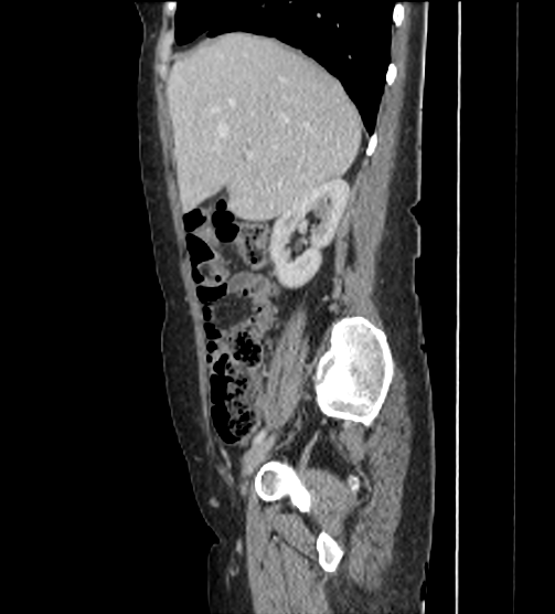 Acute pancreatitis - Balthazar E - post ERCP (Radiopaedia 27562-27772 Sagittal C+ portal venous phase 35).png