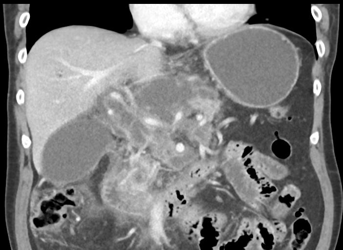 Acute pancreatitis and walled-off necrosis (Radiopaedia 29888-30404 Coronal C+ portal venous phase 25).jpg