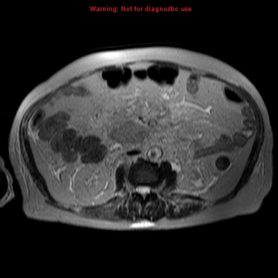 File:Acute pancreatitis with incidental pancreatic lipoma (Radiopaedia 10190-10732 Axial T2 2).jpg