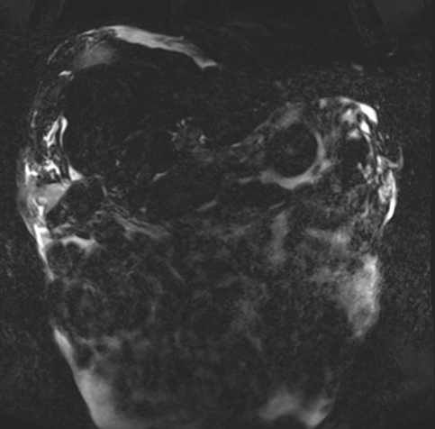 Acute portal vein thrombosis (Radiopaedia 73198-83925 Coronal Heavily T2 thin cuts 1).jpg