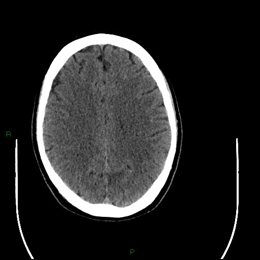 File:Acute posterior cerebral artery territory infarct (Radiopaedia 79329-92393 Axial non-contrast 72).jpg