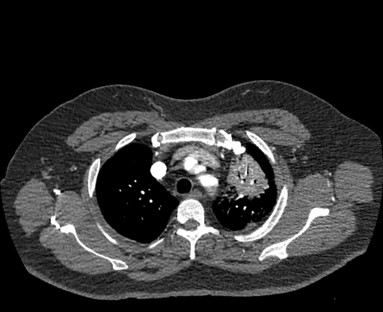 Acute pulmonary embolism with pulmonary infarcts (Radiopaedia 77688-89908 Axial C+ CTPA 10).jpg
