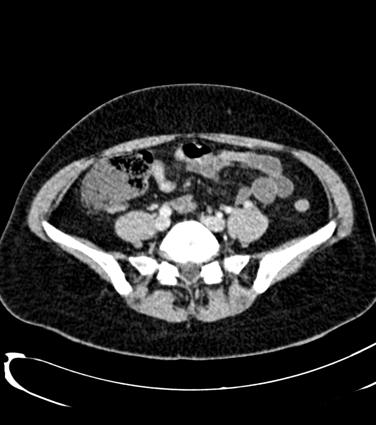 Acute pyelonephritis (Radiopaedia 40264-42816 Axial C+ portal venous phase 49).jpg