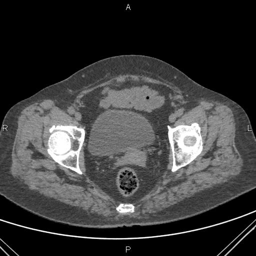 File:Acute renal artery occlusion (Radiopaedia 86586-102682 Axial non-contrast 85).jpg