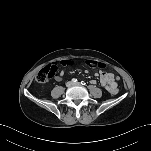 Acute renal infarction (Radiopaedia 59375-66736 Axial C+ portal venous phase 68).jpg