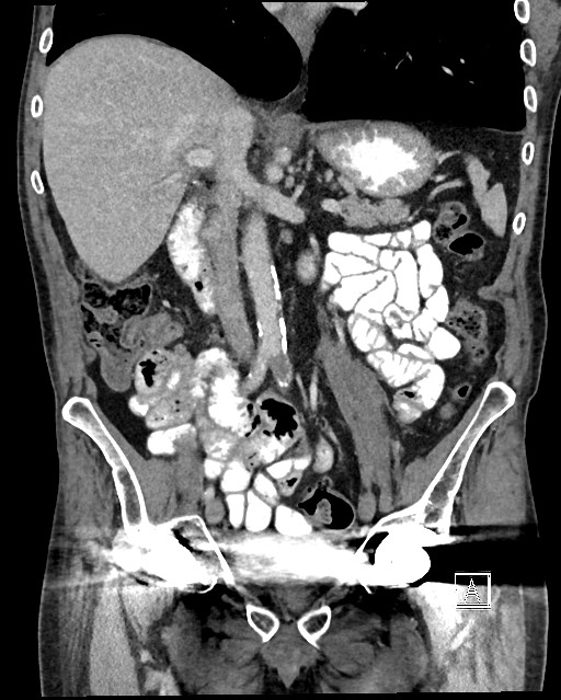 Acute renal infarction - rim capsular enhancement (Radiopaedia 59833-67270 Coronal C+ portal venous phase 25).jpg