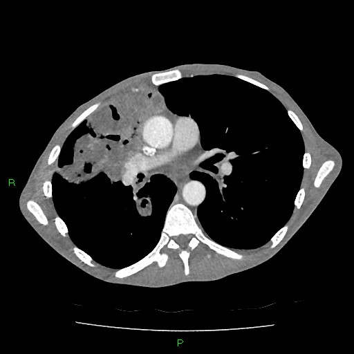 File:Acute right lung abscess (Radiopaedia 34806-36258 Axial C+ arterial phase 91).jpg