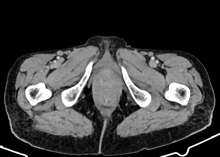 Acute small bowel (ileal) volvulus (Radiopaedia 71740-82139 Axial C+ portal venous phase 213).jpg