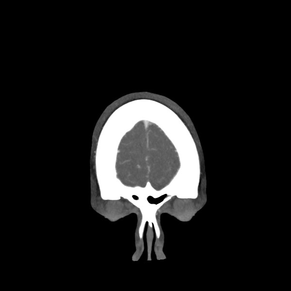 Acute subarachnoid hemorrhage and accessory anterior cerebral artery (Radiopaedia 69231-79009 Coronal C+ arterial phase 9).jpg