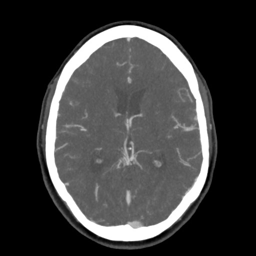 Acute subarachnoid hemorrhage and accessory anterior cerebral artery (Radiopaedia 69231-79009 D 38).jpg