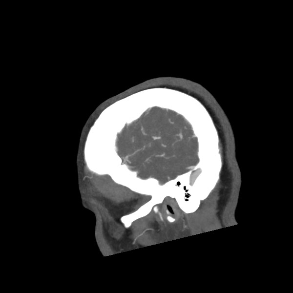 Acute subarachnoid hemorrhage and accessory anterior cerebral artery (Radiopaedia 69231-79009 Sagittal C+ arterial phase 11).jpg
