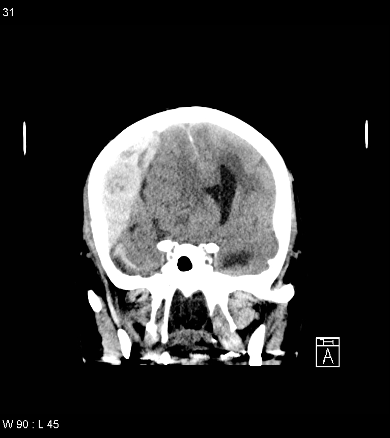 Acute subdural hematoma with myelofibrosis (Radiopaedia 52582-58494 Coronal non-contrast 22).jpg