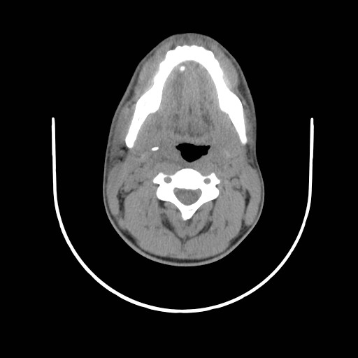 File:Acute submandibular sialadenitis secondary to ductal stone (Radiopaedia 27999-28267 Axial non-contrast 11).jpg