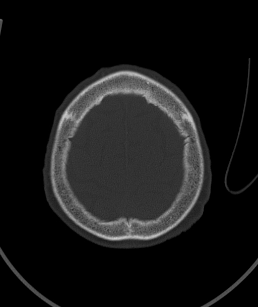 Acute traumatic subdural hematoma (Radiopaedia 82921-97257 Axial bone window 22).jpg