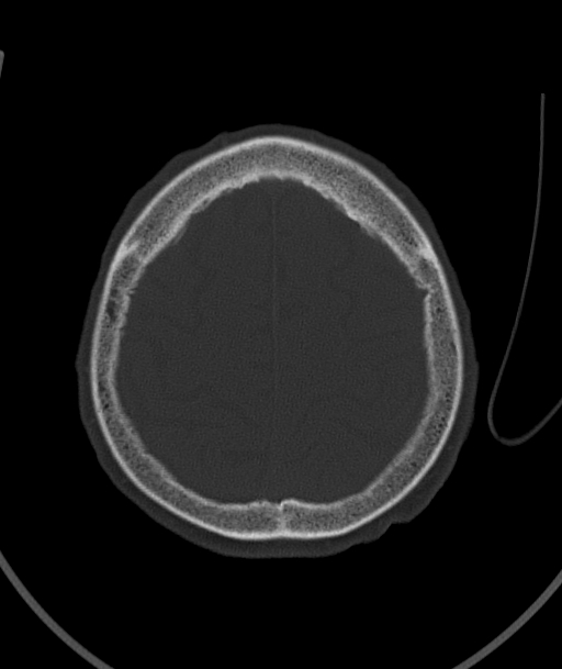 Acute traumatic subdural hematoma (Radiopaedia 82921-97257 Axial bone window 26).jpg