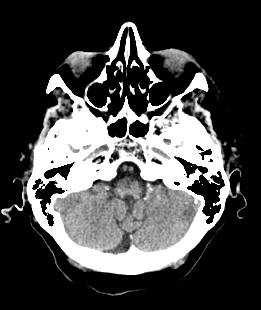 Acute traumatic subdural hematoma (Radiopaedia 82921-97257 Axial non-contrast 51).jpg