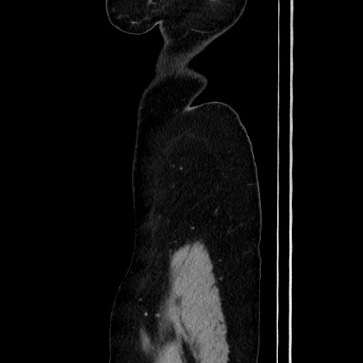 Acute uncomplicated appendicitis (Radiopaedia 73704-84499 Sagittal C+ portal venous phase 36).jpg