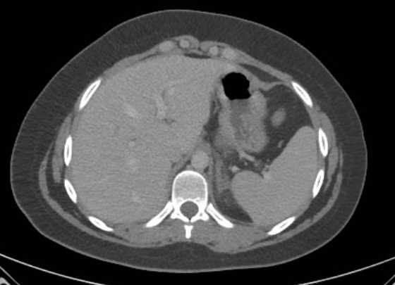 Acute unilateral nonhemorrhagic adrenal infarction (Radiopaedia 67560-76957 Axial renal parenchymal phase 11).jpg