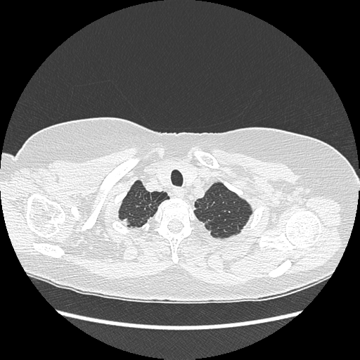 Adenocarcinoma in situ of lung (Radiopaedia 38685-40829 B 22).png