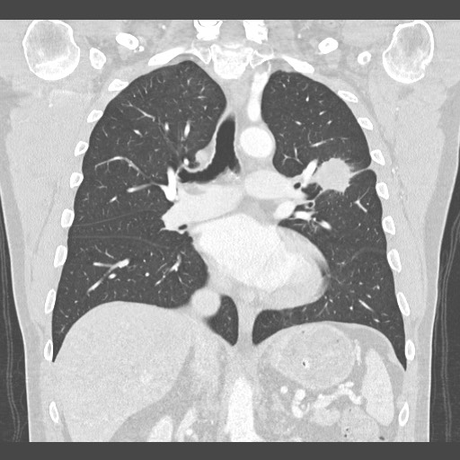 Adenocarcinoma of the lung (Radiopaedia 59871-67325 Coronal lung window 31).jpg
