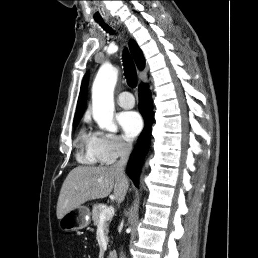 File:Adenocarcinoma of the lung (Radiopaedia 59871-67325 Sagittal C+ arterial phase 49).jpg