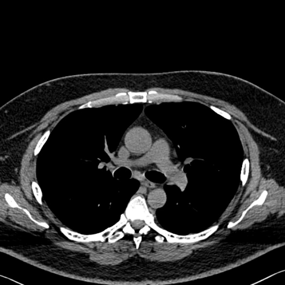 Adenoid cystic carcinoma of the trachea (Radiopaedia 49042-54137 Axial non-contrast 142).jpg
