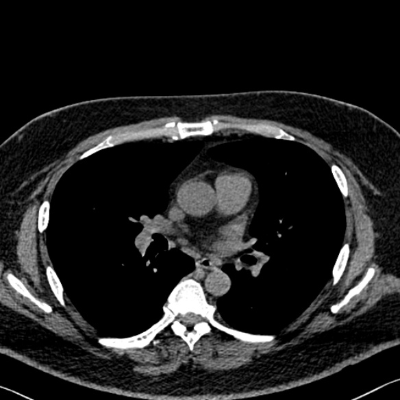Adenoid cystic carcinoma of the trachea (Radiopaedia 49042-54137 Axial non-contrast 173).jpg