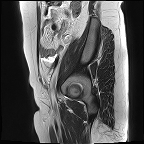 File:Adenomyosis - ovarian endometriomas (Radiopaedia 67031-76350 Sagittal T2 1).jpg