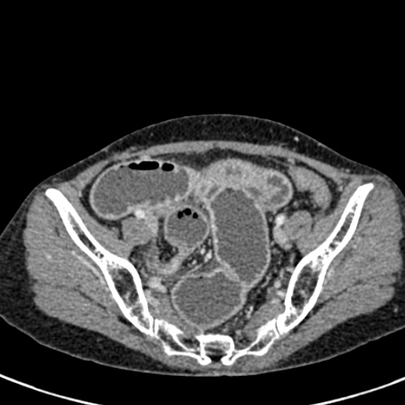Adhesional small bowel obstruction (Radiopaedia 48397-53305 Axial C+ portal venous phase 74).jpg