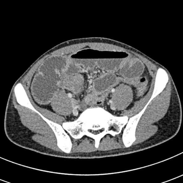 Adhesional small bowel obstruction (Radiopaedia 52107-57980 Axial C+ portal venous phase 93).jpg