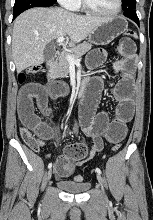 Adhesional small bowel obstruction (Radiopaedia 58900-66131 Coronal C+ portal venous phase 123).jpg