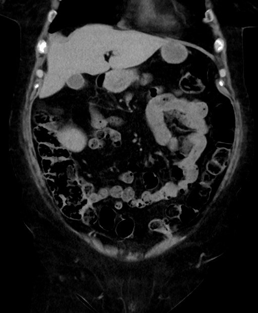 Adrenal cortical carcinoma (Radiopaedia 64017-72769 Coronal C+ delayed 21).jpg