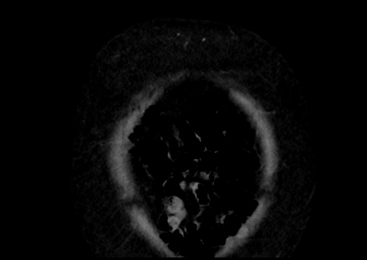 File:Adrenal cortical carcinoma (Radiopaedia 64017-72769 Coronal C+ portal venous phase 3).jpg