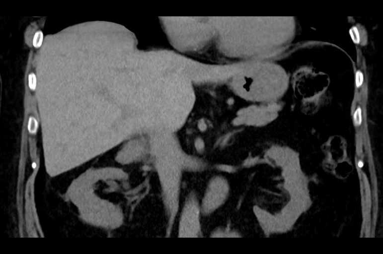 Adrenal cortical carcinoma (Radiopaedia 64017-72769 Coronal non-contrast 28).jpg