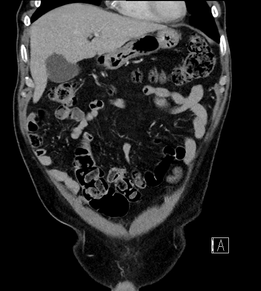 Adrenal lymphoma (Radiopaedia 73730-84529 Coronal C+ portal venous phase 21).jpg