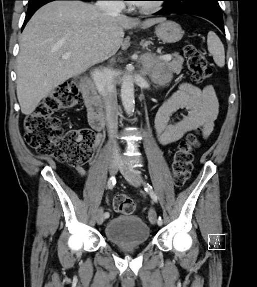 Adrenal lymphoma (Radiopaedia 73730-84529 Coronal C+ portal venous phase 40).jpg