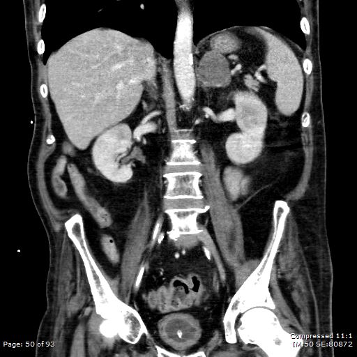 Adrenal metastasis (Radiopaedia 78425-91079 Sagittal C+ portal venous phase 37).jpg