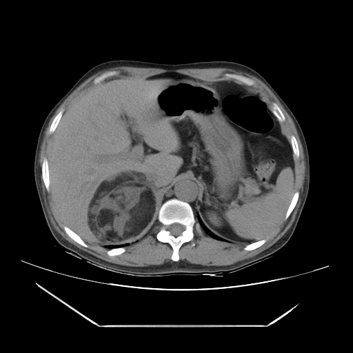 File:Adrenal myelolipoma (Radiopaedia 41843-44834 Axial non-contrast 15).jpg