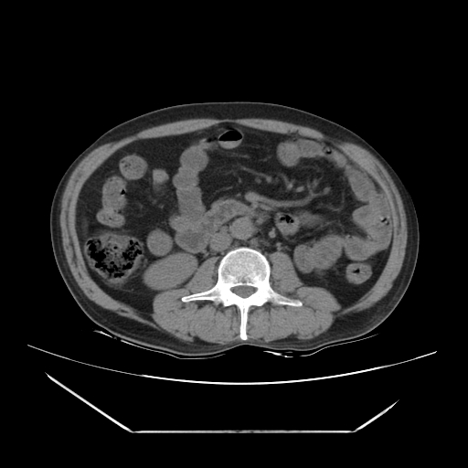 File:Adrenal myelolipoma (Radiopaedia 41843-44834 Axial non-contrast 40).jpg