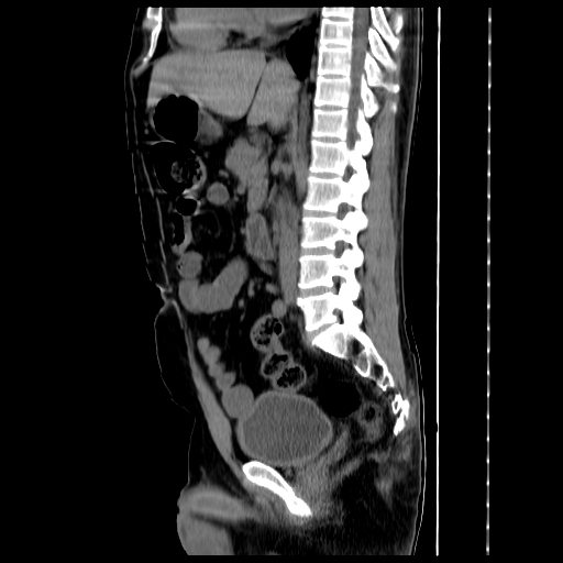File:Adrenal myelolipoma (Radiopaedia 41843-44834 Sagittal non-contrast 22).jpg