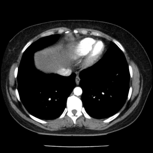 File:Adrenal myelolipoma (Radiopaedia 43401-46759 Axial C+ arterial phase 6).jpg