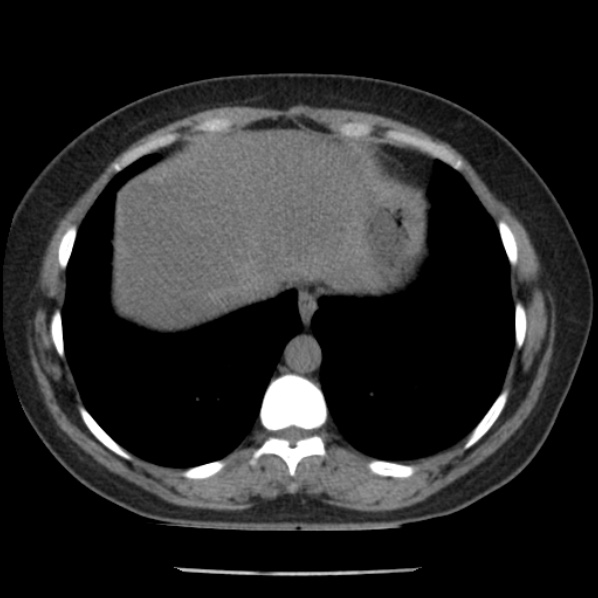 Adrenal myelolipoma (Radiopaedia 43401-46759 Axial non-contrast 9).jpg