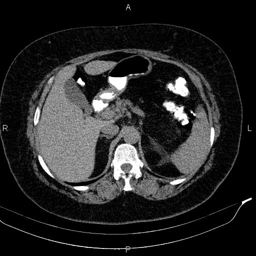 Adrenal myelolipoma (Radiopaedia 84319-99617 Axial With oral contrast 66).jpg